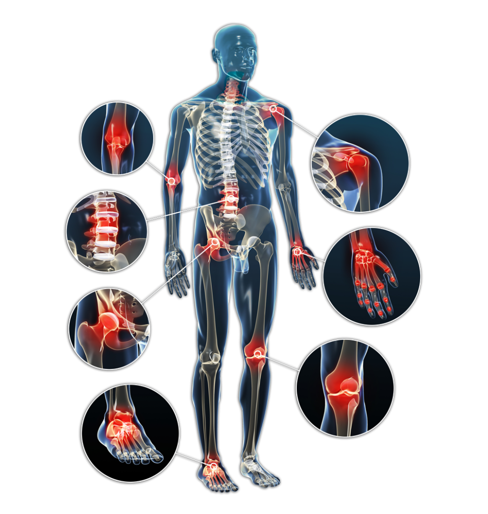 Ursachen für chronische Schmerzen können zum Beispiel Erkrankungen wie Arthrose, Bandscheibenvorfälle, Wirbelsäulenerkrankungen oder entzündliche Prozesse im Bewegungsapparat sein und sich unterschiedlich äußern

    Nackenschmerzen
    Rückenschmerzen
    Gelenkschmerzen
    Schmerzen der Muskulatur und der Weichteile
    Nervenschmerzen
    Komplexes Regionales Schmerzsyndrom
    Somatoforme Schmerzsyndrome
    Fibromyalgiesyndrom
